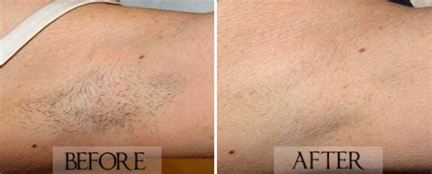 Our expert staff provides the highest quality care and. Everything To Know About Laser Genesis Toronto | Best ...