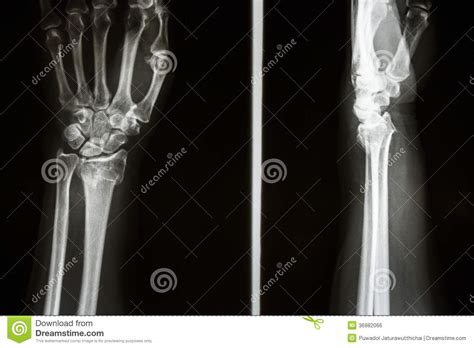 La frattura di Colles fotografia stock. Immagine di ...