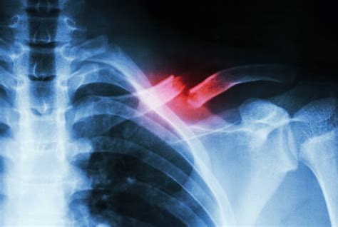 Warning Symptoms Of Broken Collarbone In Children Vinmec