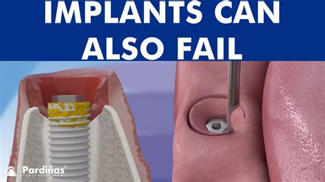 Peri Implantitis Dental Implant Infection © Dental Clinic