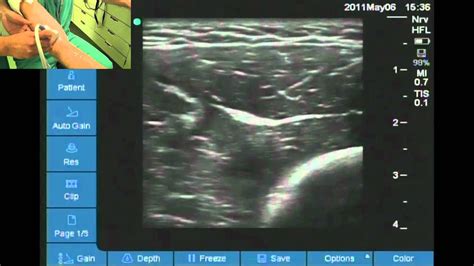 Ultrasound Location Of Radial Nerve At Elbow Youtube