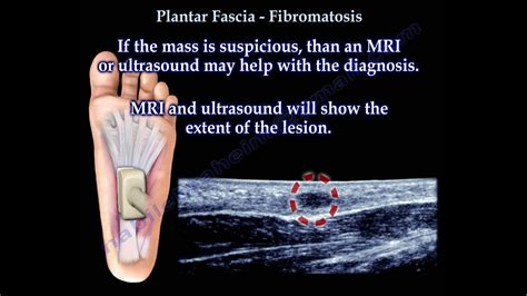 Plantar Fascia Plantar Fibromatosis Everything You Need To Know Dr