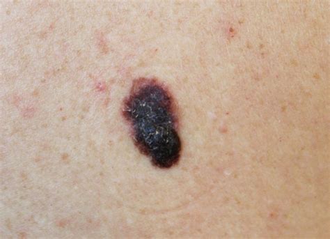 Cancerous Mole Front Range Dermatology