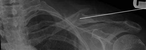 Fractured Collarbone Clavicle