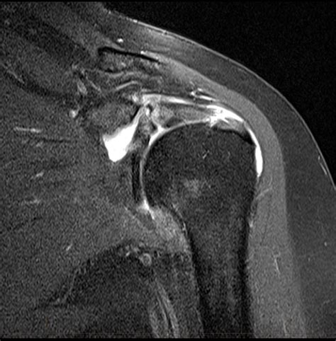 Mri Shoulder Supraspinatus Tendon Tear 7 Mri At Melbourne Radiology