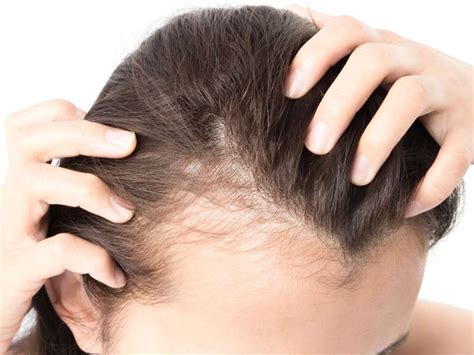 Receding Hairline In Women Signs Causes Reversal Surgery Hair