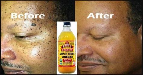 How To Use Apple Cider Vinegar To Remove Your Own Skin Tags At Home
