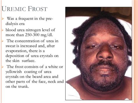 Uremic Frost In Ckd Uremic Frost Information Including Symptoms