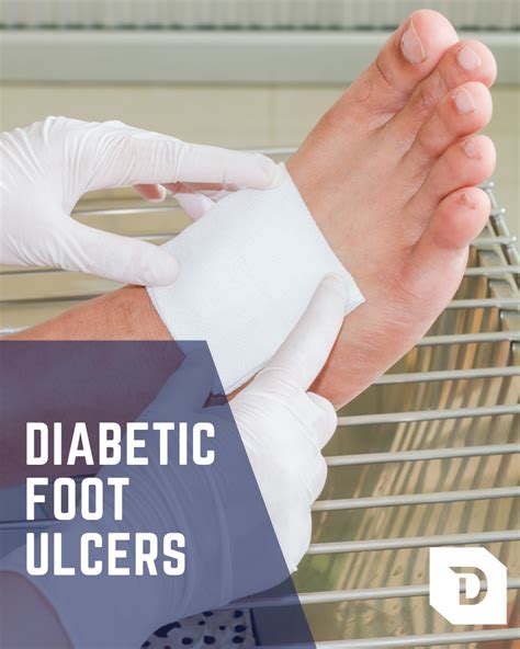 Diabetic Foot Ulcers Foot Ulcer Treatment Alexandria Va