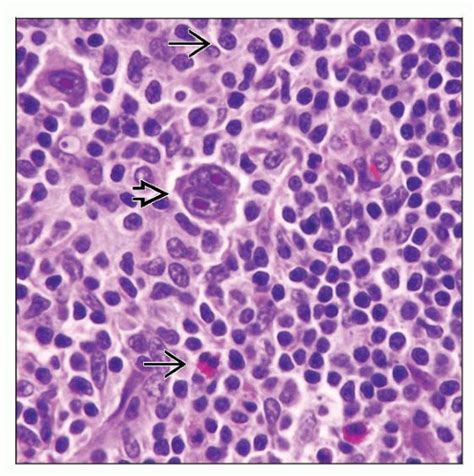 Mixed Cellularity Hodgkin Lymphoma Basicmedical Key