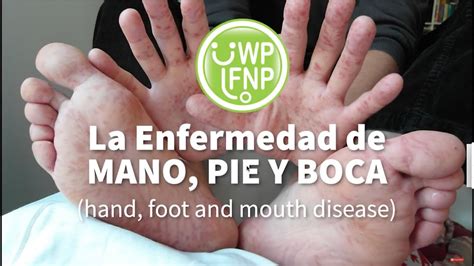 La Enfermedad De Mano Pie Y Boca Hand Foot And Mouth Disease Youtube