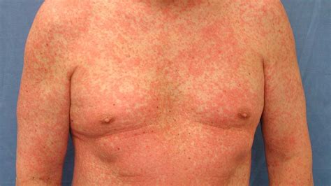 Rash Common Skin Rashes Pictures Causes And Treatment