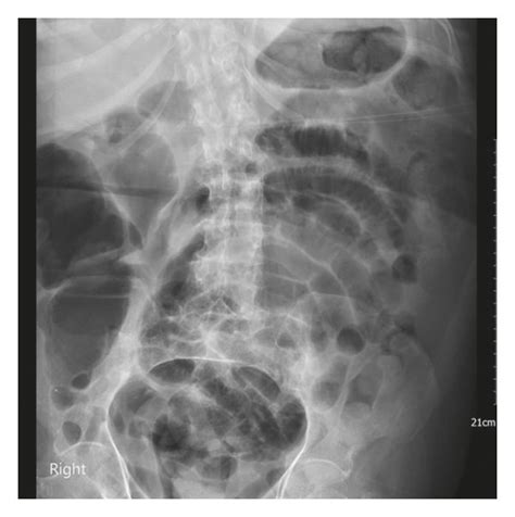 Diffuse Gaseous Distention Of The Bowel Consistent With Ileus Seen On