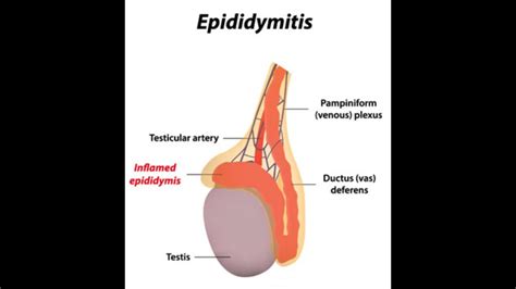 The Term Orchiepididymitis Means Inflammation Of The