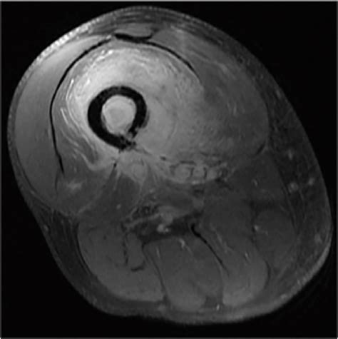 Axial T1 Fat Suppression Post Contrast Mri At Time Of Index
