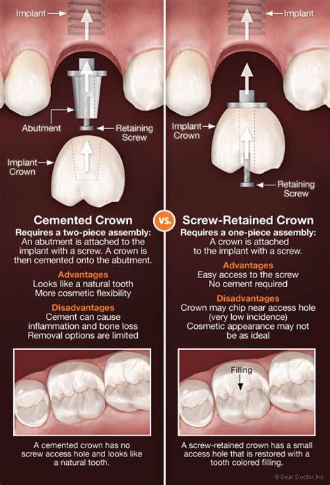 How Crowns Attach To Dental Implants