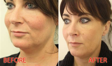 What Is A Thread Lift Before And After Pictures Show Anti Ageing