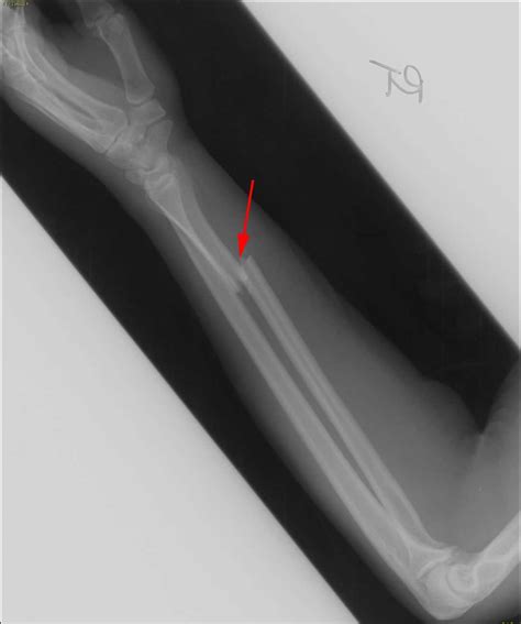 Galeazzi Fracture X Rays Case Studies Ctisus Ct Scanning