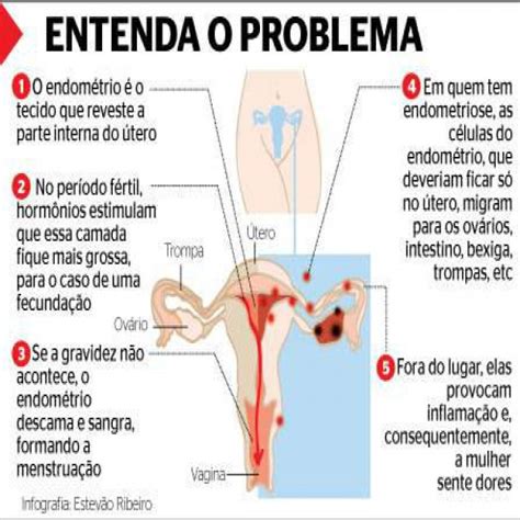 Als endometriose wird das vorkommen von endometriumähnlichem gewebe außerhalb der gebärmutterhöhle (cavum uteri) bezeichnet. Tratamento Gratuito para Endometriose