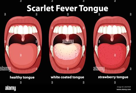 Scarlet Fever Tongue Symptoms Illustration Stock Vector Image And Art Alamy