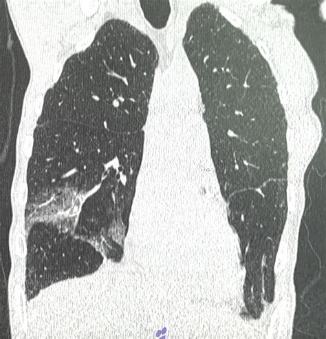 Computed Tomography Of Thorax Of The Patient N 1 With 20 Of Viral