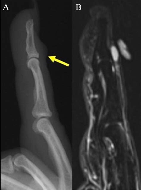 Digital Mucus Cyst A Lateral Radiograph Of Index Finger Demonstrates