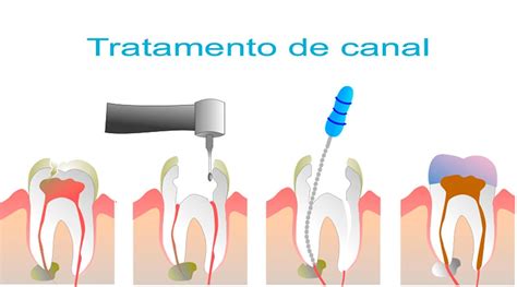 O Que Tratamento Endod Ntico Cl Nica Odontol Gica Em Copacabana Dentista Em Copacabana