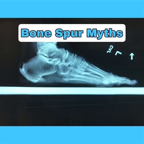 Bone Spur Myth. | Heel Pain | Valley Foot Care, Inc.