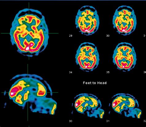 Study What If Mental Health Is Really Brain Health