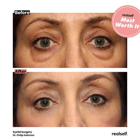Eyelid Thread Lift Before And After