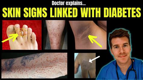Doctor Explains 12 Skin Conditions Associated With Diabetes Diabetes