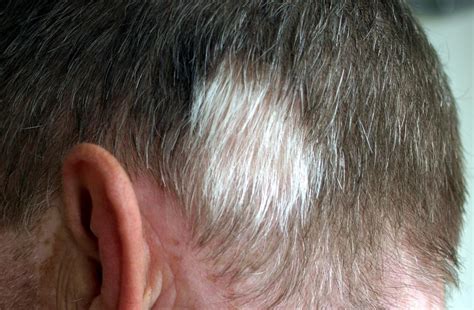Poliosis Causes Symptoms And Treatment