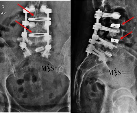 Oblique Lateral Lumbar Interbody Fusion Olif Morgenstern Institute