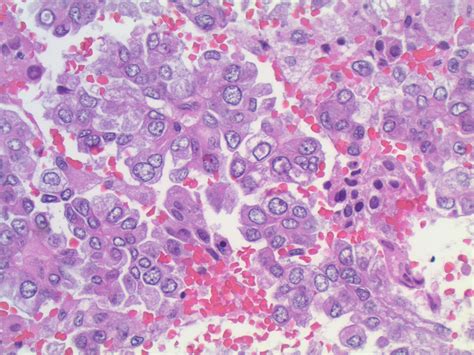 Pathology Outlines Adenocarcinoma General