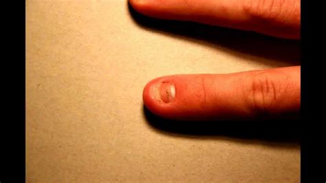 Time Lapse Of Fingernail Growing Back Youtube