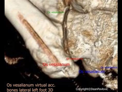 Os vesalianum at 5th metatarsal 2 - YouTube