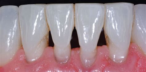 Treating Dental Black Triangles Caven Dental Group