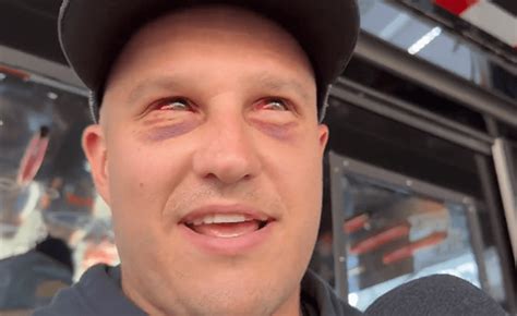 Nascar Driver Ryan Preece Shows Off Bruised And Bloody Eyes After