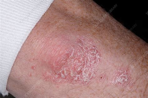 Plaque Psoriasis On Elbow Stock Image M2400751 Science Photo Library
