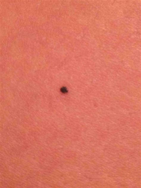Should I Have This Black Freckle Examined Rdermatology
