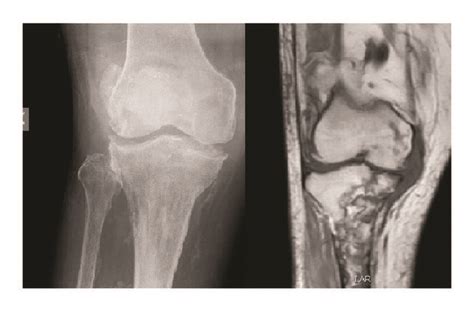 Osteomyelitis X Rays