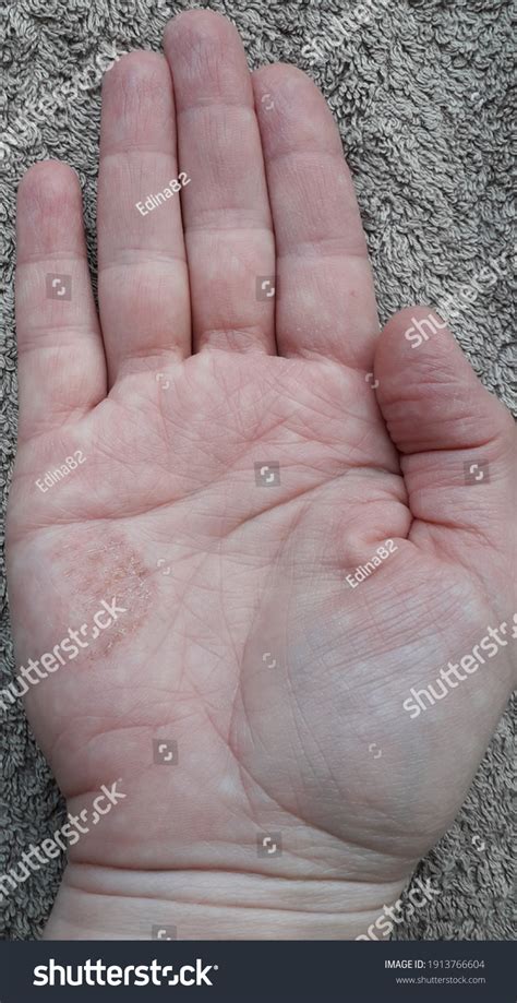 Hand Eczema Dyshidrotic Eczema On Palm Stock Photo 1913766604