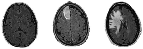 Brain Tumor Classification In Mri Image Using Convolutional Neural