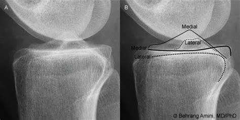 Roentgen Ray Reader Landmarks On The Lateral View Of The Proximal Tibia