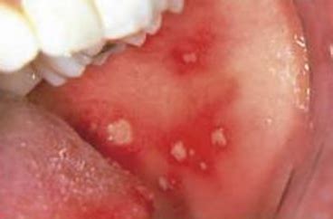 Red spots on the roof of the mouth can be caused by a variety of reasons. White Sore in Mouth, Inside of Lip, Cheek, on Gum, Back of Throat, std, Home Remedy Get Rid and ...