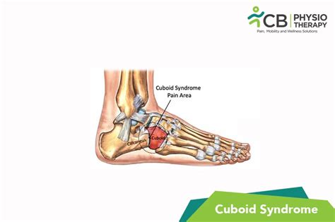 What Is Cuboid Syndrome Symptoms Causes Diagnosis And Physiotherapy