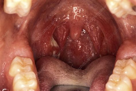 Ulcerated Tonsils Throat Examination Stock Image M270 0340 Science Photo Library