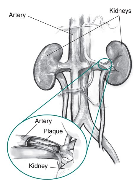 The process starts with the renal artery which enters the kidney as afferent arteriole. Renal Blood Vessels Labeled / Kidney Blood Supply Diagram ...
