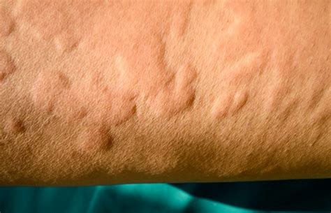 Different Skin Allergies Causes And Treatments Health24