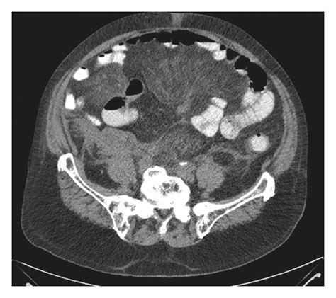 Ct Scan Of The Abdomen Without Contrast Revealing Mesenteric Thickening